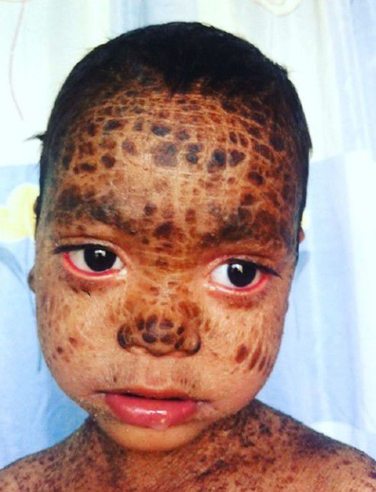 lamellar ichthyosis treatment