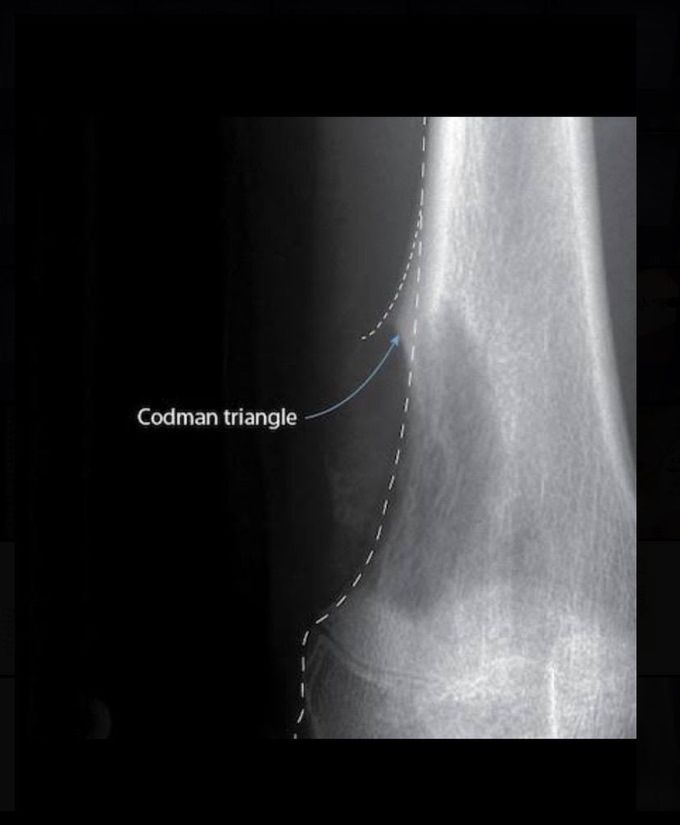 Codman triangle