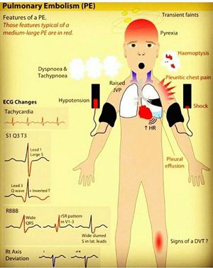 Pulmonary embolism... - MEDizzy