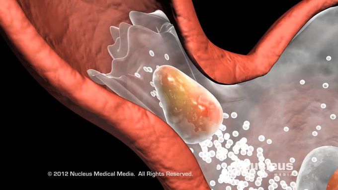 Introduction to Fundoplication