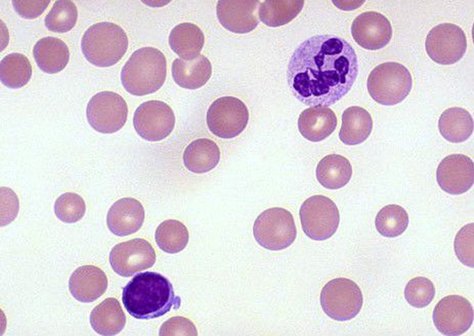 Megaloblastic anemia