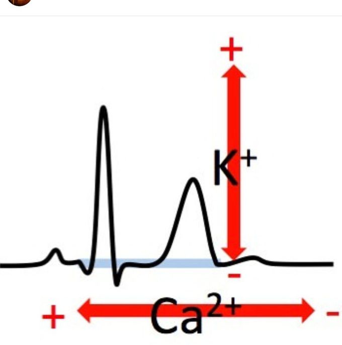 ECG Changes