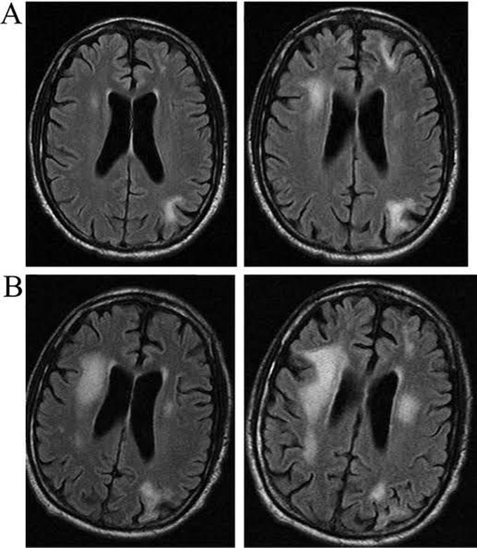 Progressive Multifocal leukoencephalopathy