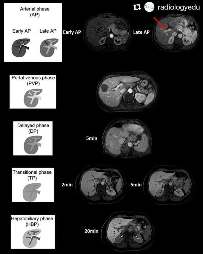 MRI phases of the liver