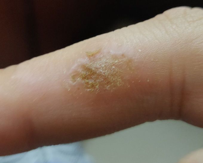 Identify the Lesion and treatment for the same !