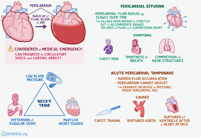 Sign and symptoms of cardiac temponade