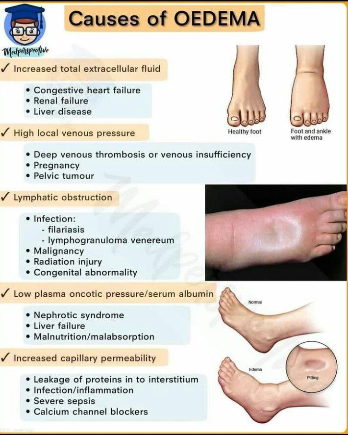 What Causes Edema In The Left Leg