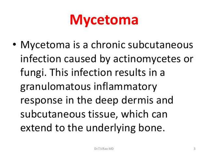 Mycetoma