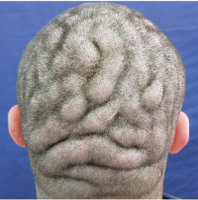 scalp-disease-medizzy