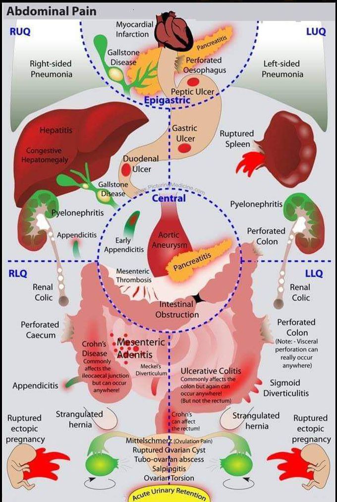 Types of Abdominal Pain