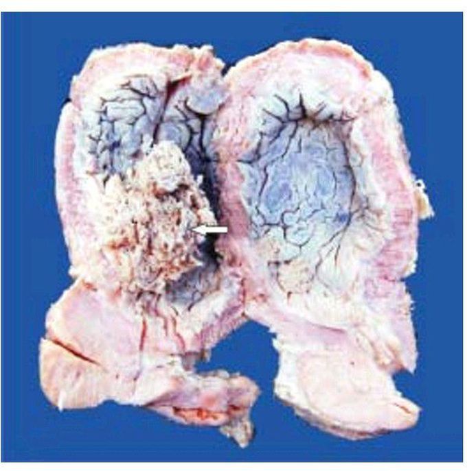 Carcinoma urinary bladder .