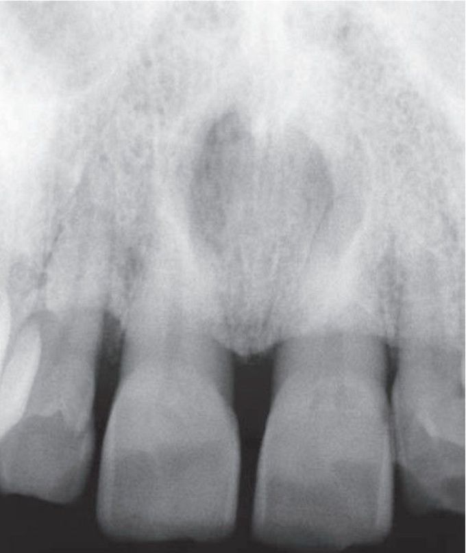 Nasopalatine duct cyst (Heart shaped)