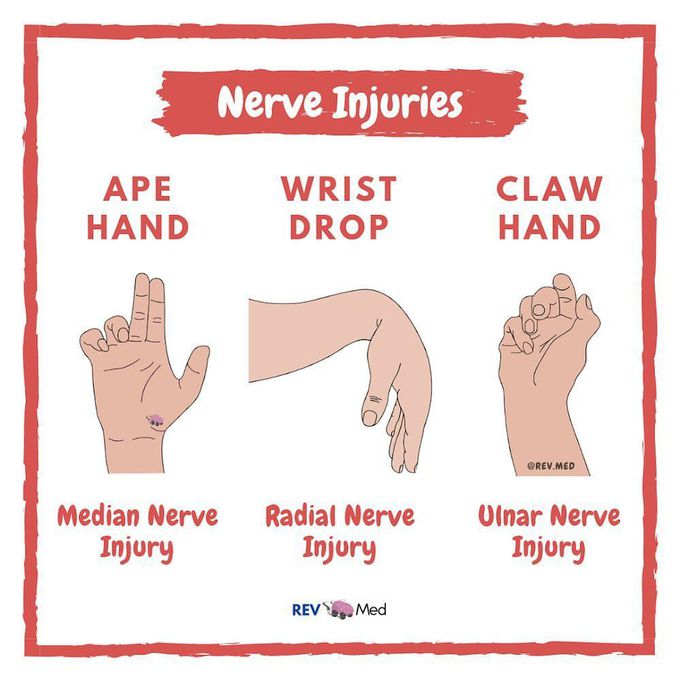 Nerve injury mn DrCuMa