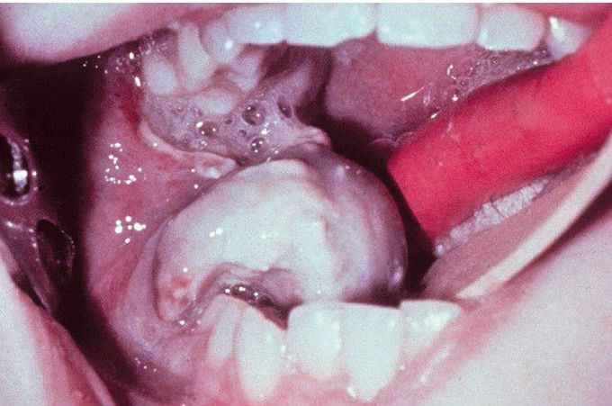 Ewing Sarcoma