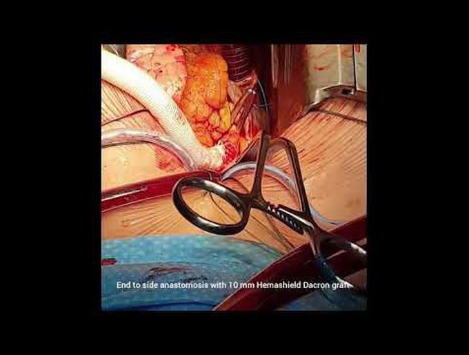 Transaortic Impella LD Implantation
