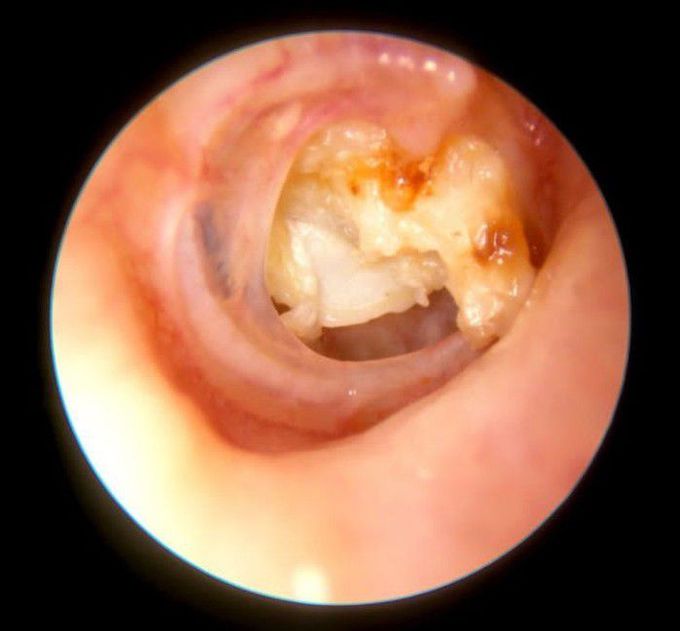 Cholesteatoma