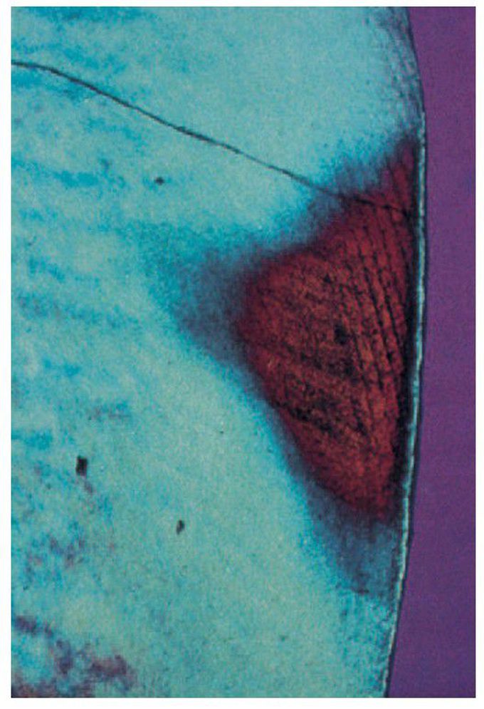Early interproximal caries.