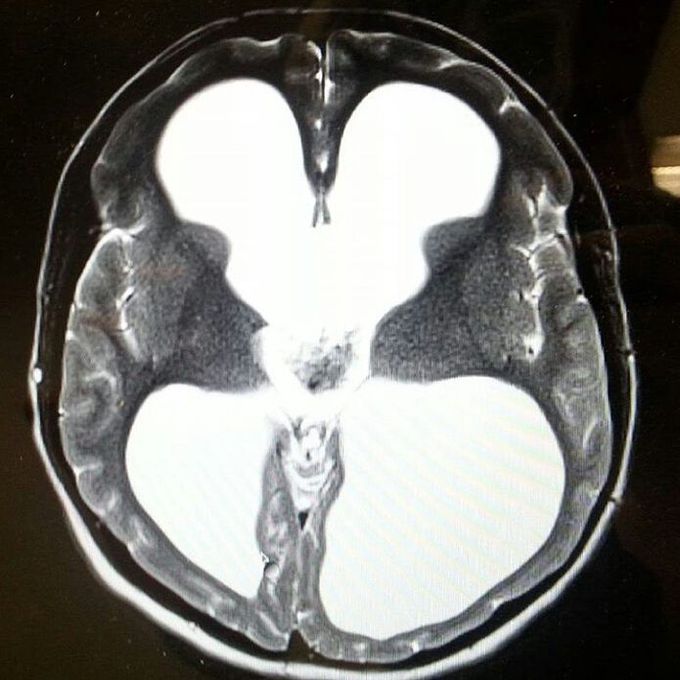 Congenital Hydrocephalus