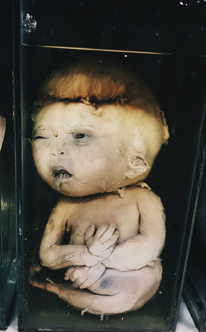 Fetus
