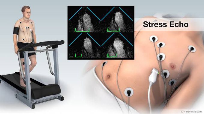 Stress echocardiography