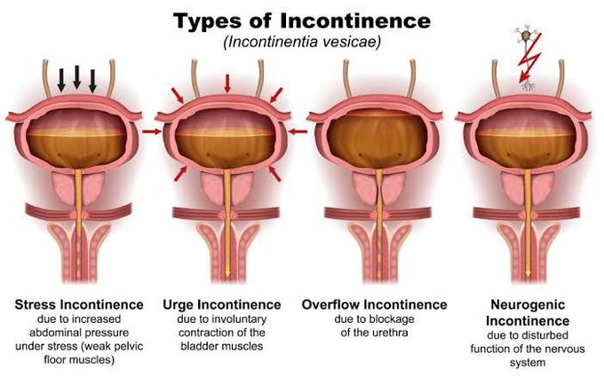 Sign and symptoms of urinary incontinence