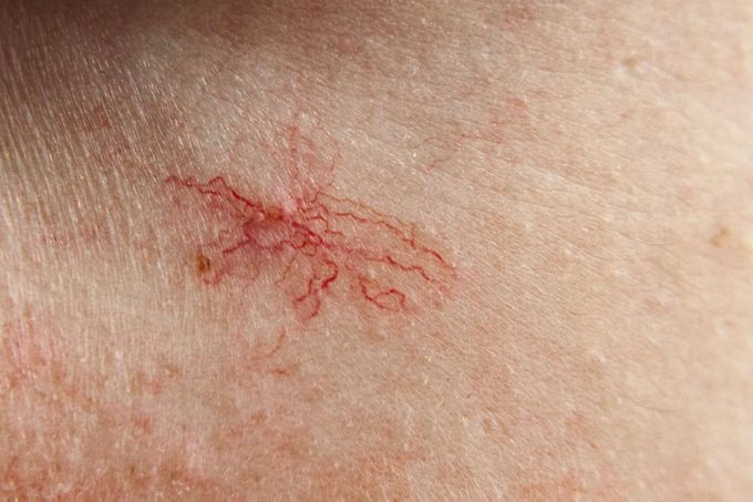 How can spider nevus be prevented?