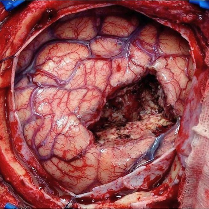 Brain tumor