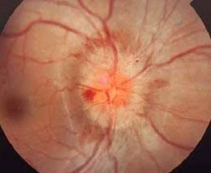 Optic neuritis