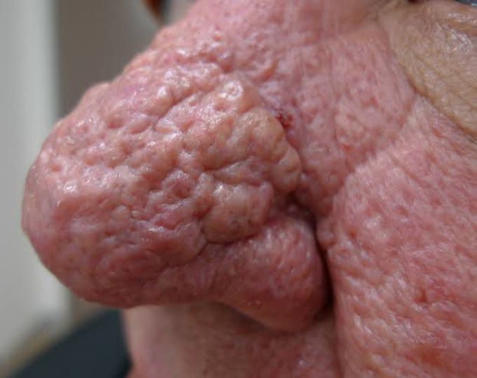 Rhinophyma