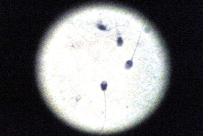 3D printing re-engineers sperm to fight gynecological cancer