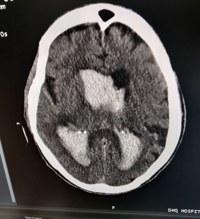 Hemorrhagic CVA