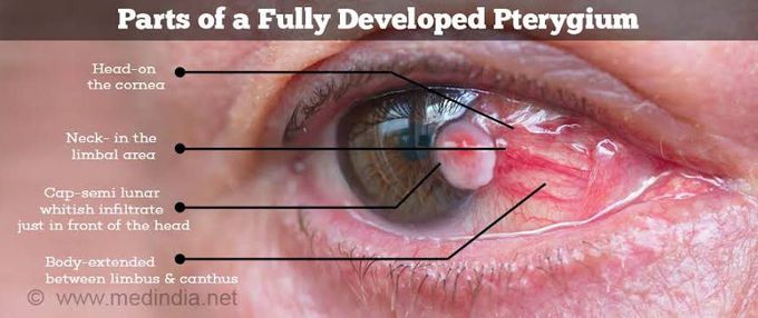 Pterygium