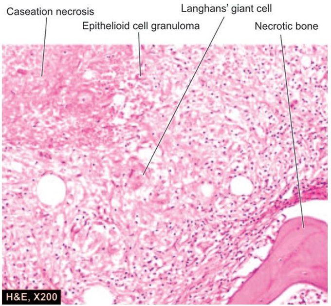 Tuberculous osteomyelitis