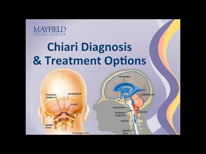 Chiari Malformation: Overview