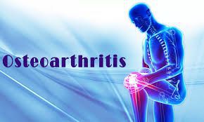 Osteoarthritis - MEDizzy