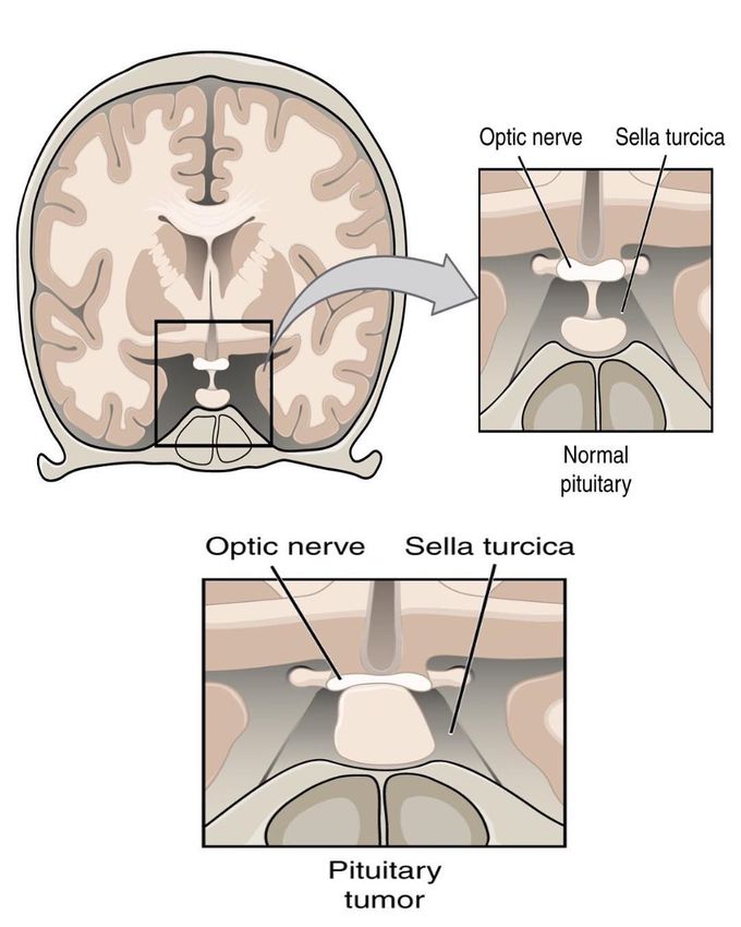 People with a pituitary gland tumor may experience the following symptoms or signs