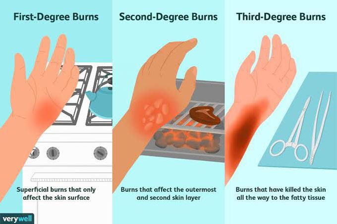 Degrees of burns