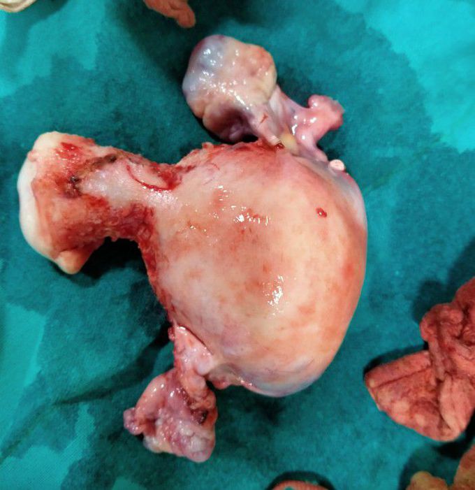 Fibroid