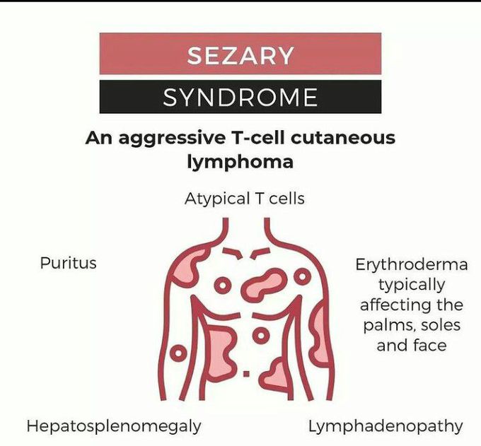 Sezary Syndrome