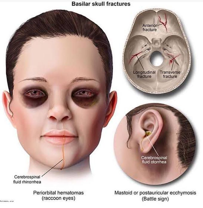 Basilar skull fracture MEDizzy