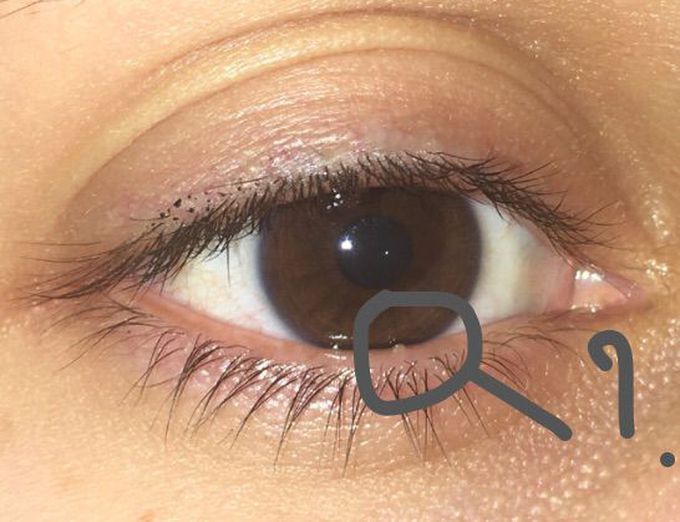 Eye problem