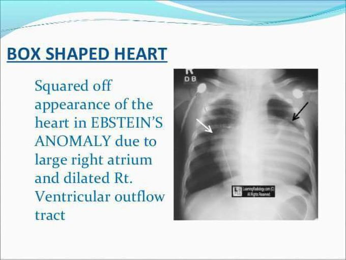 Ebsteins anomaly