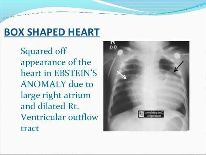 Ebsteins anomaly - MEDizzy