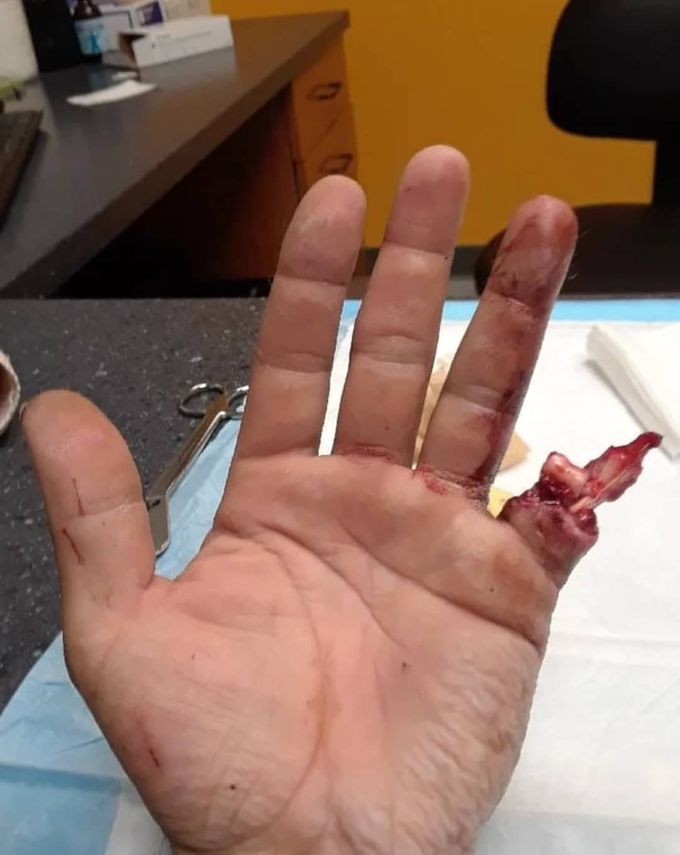 ⚠️ Finger amputation after a drill accident at work! 