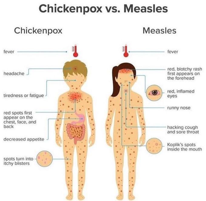 Chickenpox vs Measles