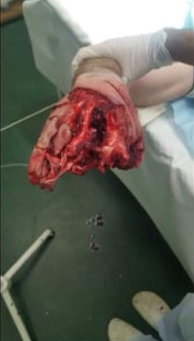 Hand amputation.