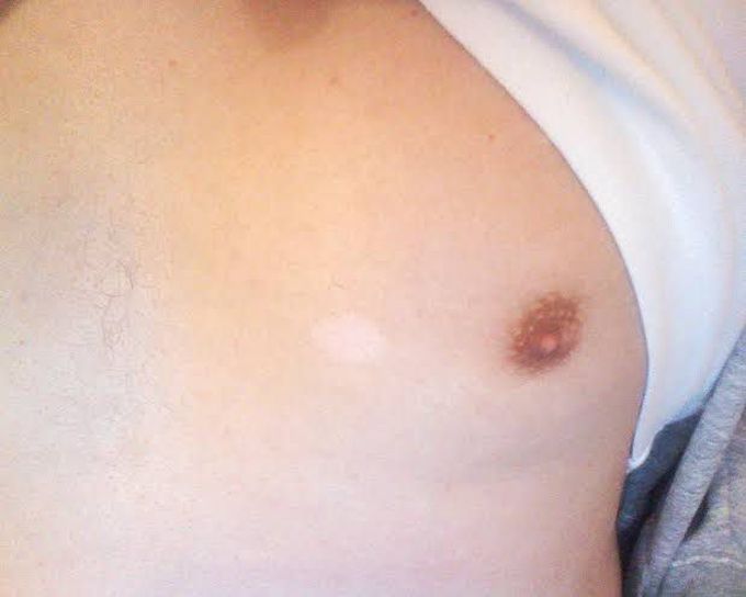 Nevus Achromicus / Birthmark