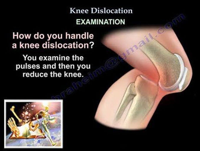 Knee Dislocation - Everything You Need To Know - Dr. Nabil Ebraheim