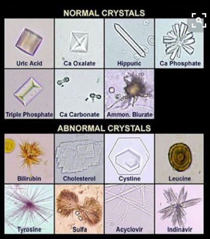 Urine Crystals