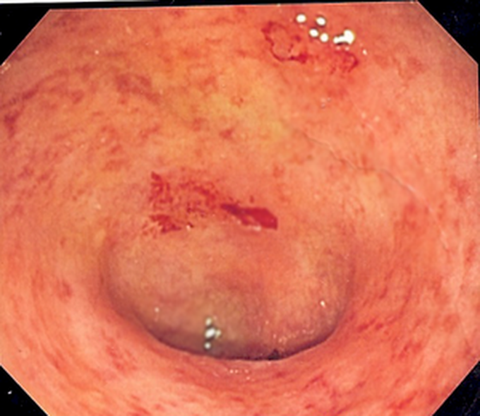 Ulcerative colitis